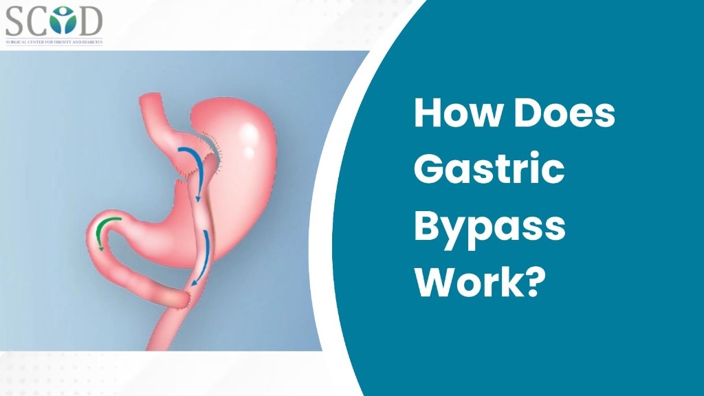 How Does Gastric Bypass Work?