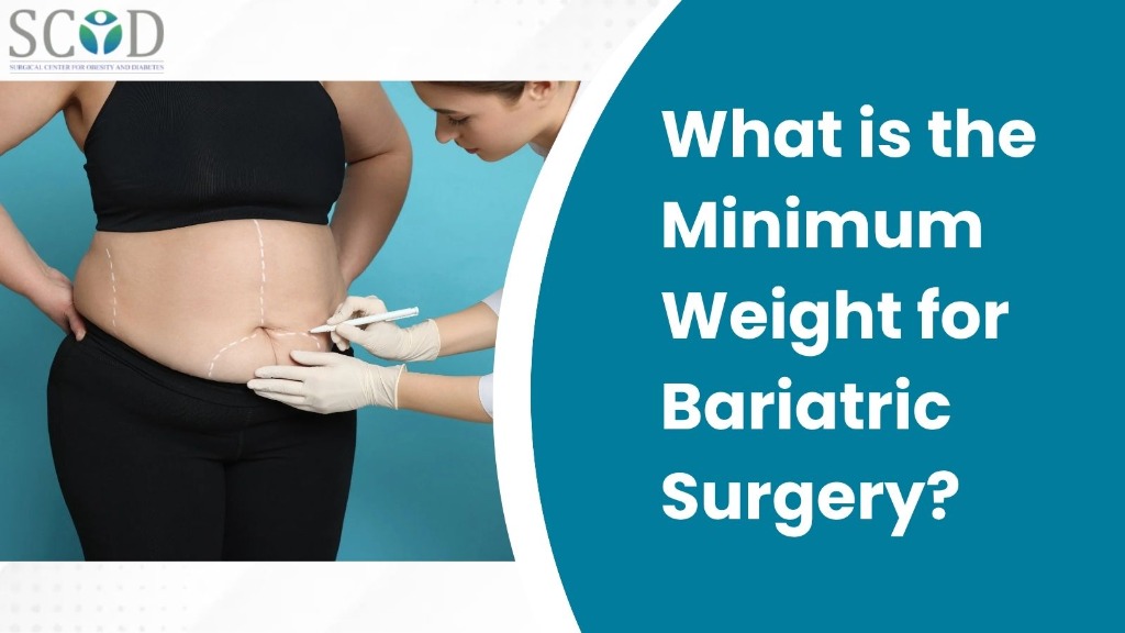 What is the Minimum Weight for Bariatric Surgery?