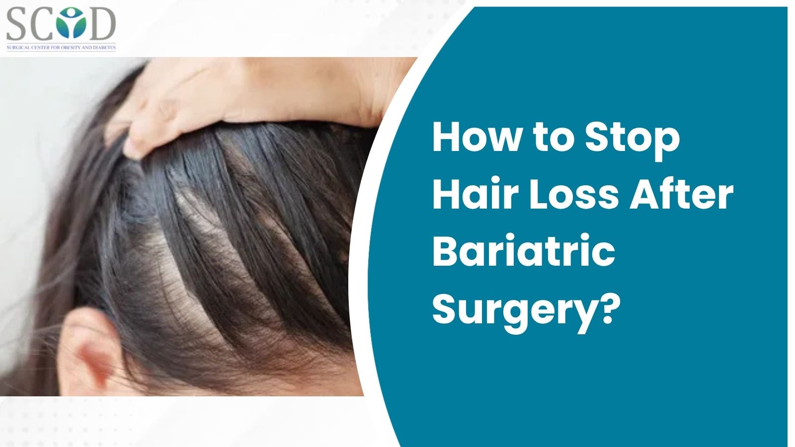 How to Stop Hair Loss After Bariatric Surgery?